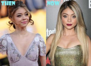 Sarah Hyland Plastic Surgery