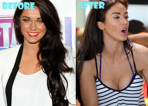 Vicky Pattison Plastic Surgery Breast Implant