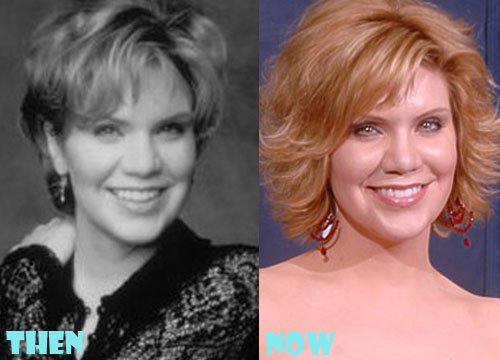 Alison Krauss Plastic Surgery Before and After Photo