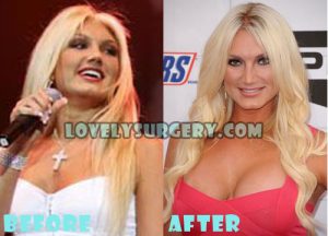 Brooke Hogan Plastic Surgery