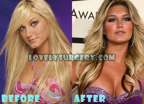 Brooke Hogan Plastic Surgery Before and After Photos