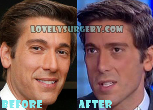 David Muir Plastic Surgery Before and After Photo