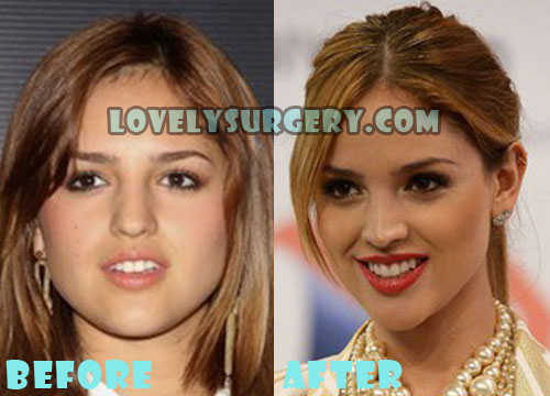 Eiza Gonzalez Plastic Surgery Before and After Photos