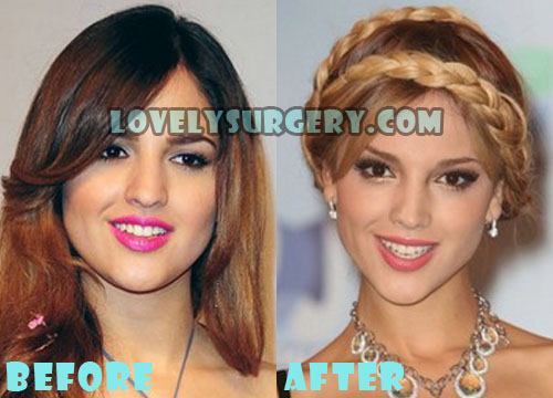 Eiza Gonzalez Plastic Surgery Before and After.