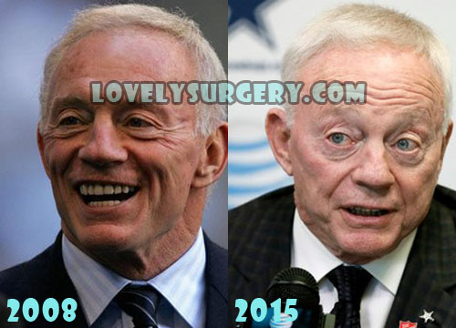 Jerry Jones Plastic Surgery Before and After Facelift