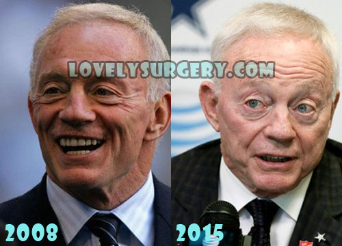 Jerry Jones Plastic Surgery Facelift