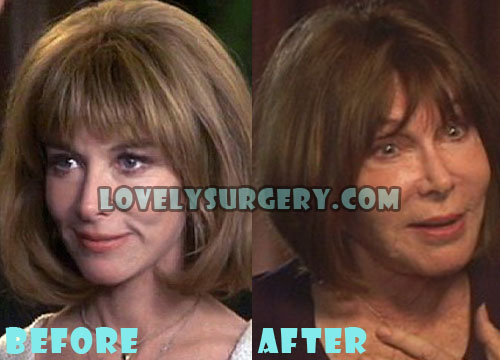 Lee Grant Plastic Surgery Gone Wrong Before and After