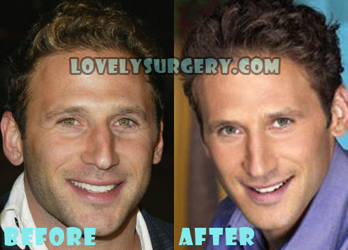 Mark Feuerstein Plastic Surgery Before and After Photos