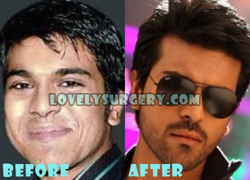 Ram Charan Teja Plastic Surgery Before and After Picture