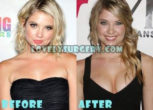 Ashley Benson Plastic Surgery