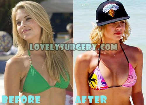 Ashley Benson Plastic Surgery Before and After Boob Job