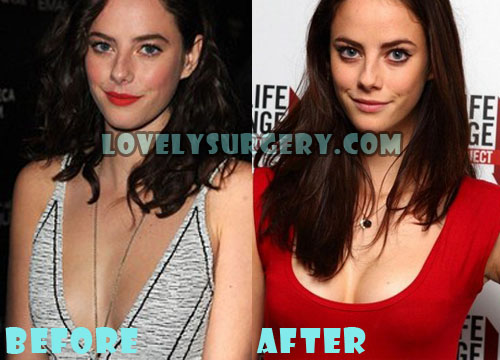 Kaya Scodelario Plastic Surgery Breast Implant