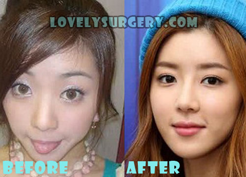 Park Han Byul Plastic Surgery Before and After Photo