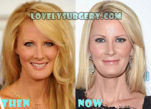 Sandra Lee Plastic Surgery Before and After Picture