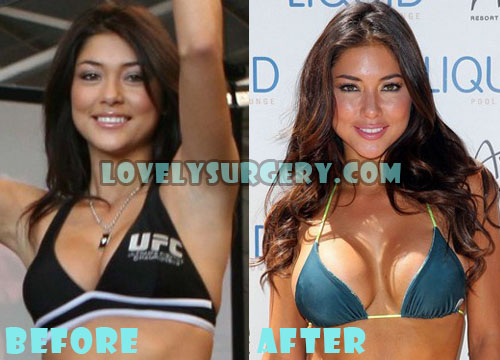 Arianny Celeste Plastic Surgery Before and After Boob Job