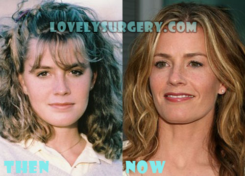 Elisabeth Shue Plastic Surgery Before and After Photo