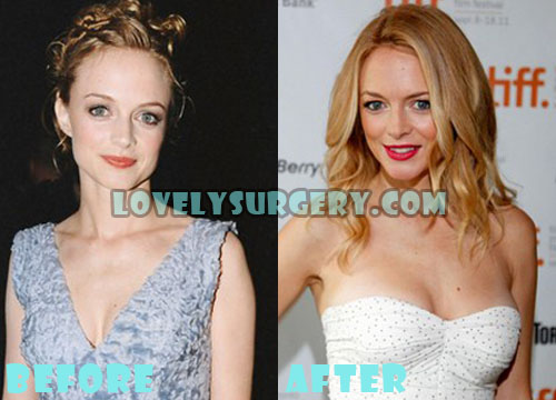 Heather Graham Plastic Surgery Before and After Photos