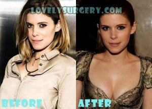Kate Mara Plastic Surgery Breast Implant