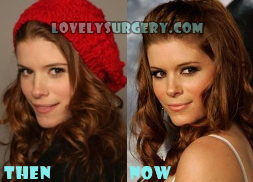 Kate Mara Plastic Surgery Before and After Photos