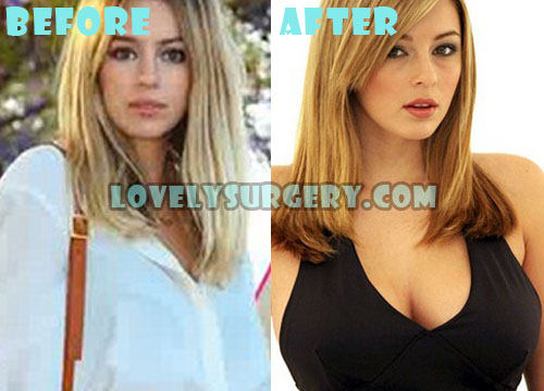 Keeley Hazell Plastic Surgery Before and After Boob Job