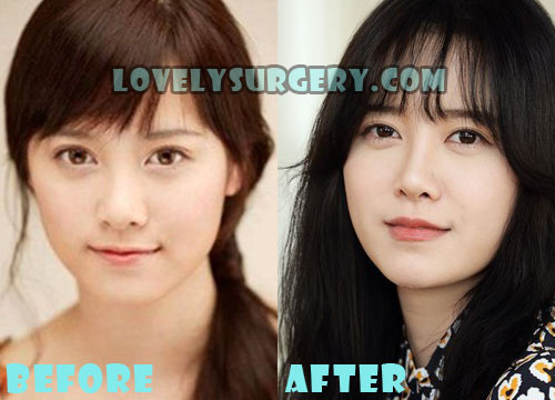 Ku Hye Sun Plastic Surgery Before and After Photos