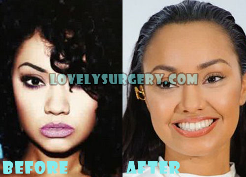 Leigh-Anne Pinnock Plastic Surgery Before and After Photo