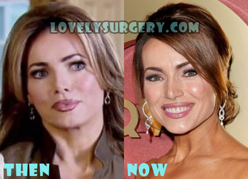 Lisa Robertson Plastic Surgery Before and After Photo