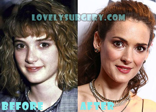 Winona Ryder Plastic Surgery Before and After Photos