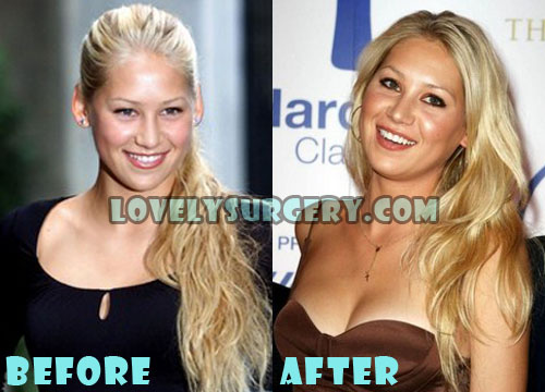 Anna Kournikova Plastic Surgery Breast Implant