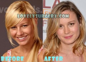 Brie Larson Plastic Surgery Nose Job