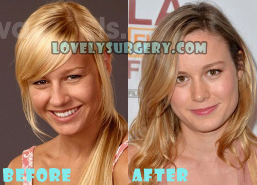 Brie Larson Plastic Surgery Before and After Rumor