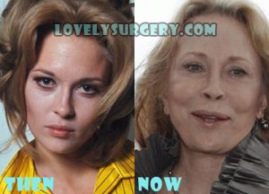 Faye Dunaway Bad Plastic Surgery
