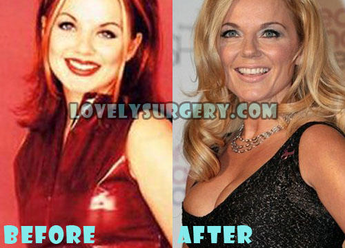 Geri Halliwell Plastic Surgery Boob Job