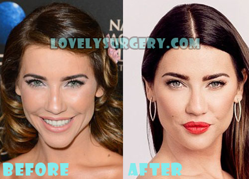 Jacqueline MacInnes Wood Plastic Surgery Lip Job