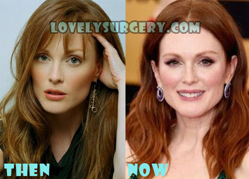 Julianne Moore Plastic Surgery Botox, Facelift