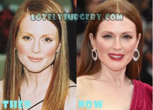 Julianne Moore Plastic Surgery Rumor