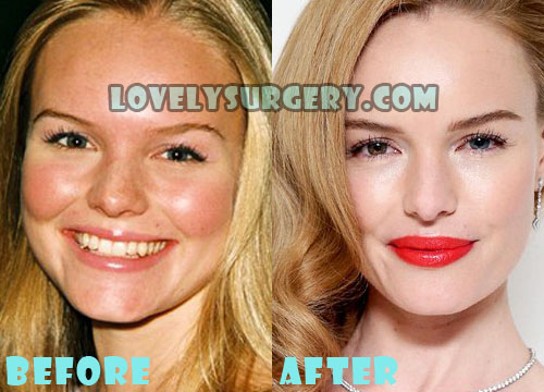 Kate Bosworth Plastic Surgery Before and After Rhinoplasty