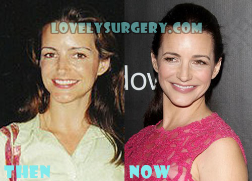 Kristin Davis Plastic Surgery Before and After Photos