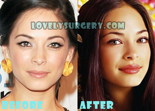 Kristin Kreuk Plastic Surgery Before and After Photos