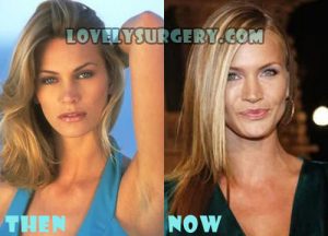 Natasha Henstridge Plastic Surgery Botox
