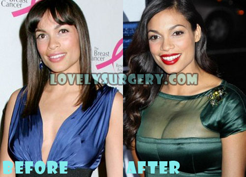 Rosario Dawson Plastic Surgery Before and After Boob Job