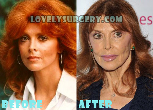 Tina Louise Plastic Surgery Botox Gone Wrong