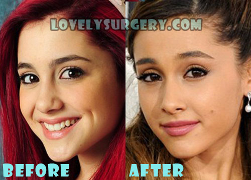 Ariana Grande Plastic Surgery Before and After Nose Job