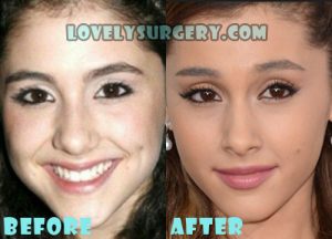 Ariana Grande Plastic Surgery Rhinoplasty