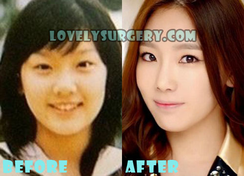 SNSD (Girls’ Generation) Kim Taeyeon Plastic Surgery