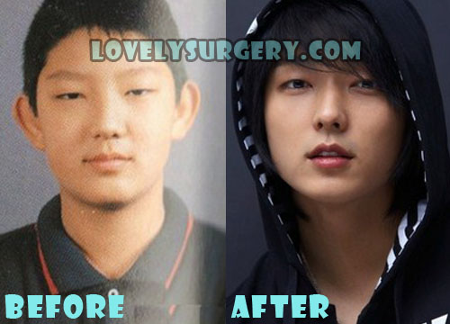 Lee Joon Gi Plastic Surgery Before and After Rhinoplasty Rumor