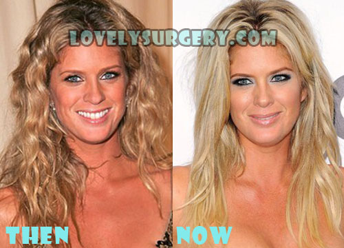 Rachel Hunter Plastic Surgery Before and After Rumor