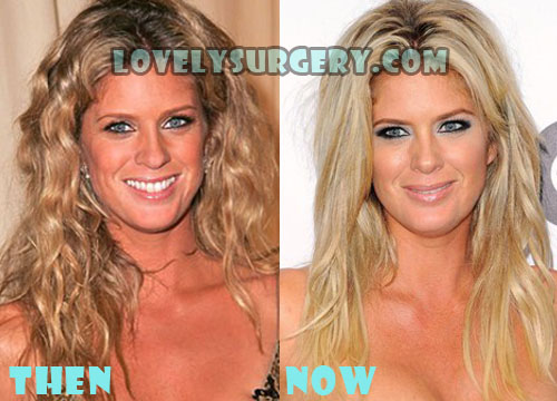 Rachel Hunter Plastic Surgery Rumor