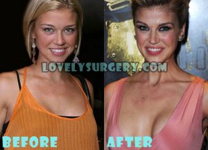 Adrianne Palicki Plastic Surgery Boob Job