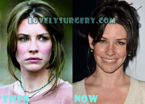 Evangeline Lilly Plastic Surgery Botox